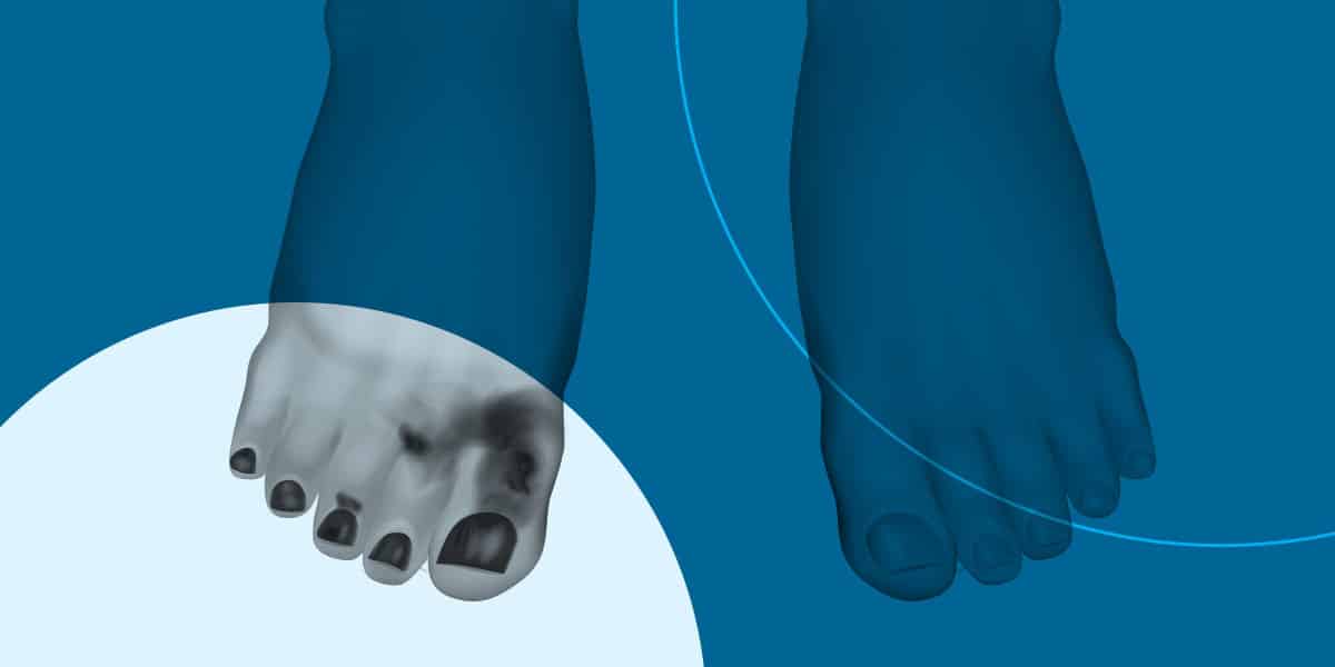 Gangrene Infection in Feet