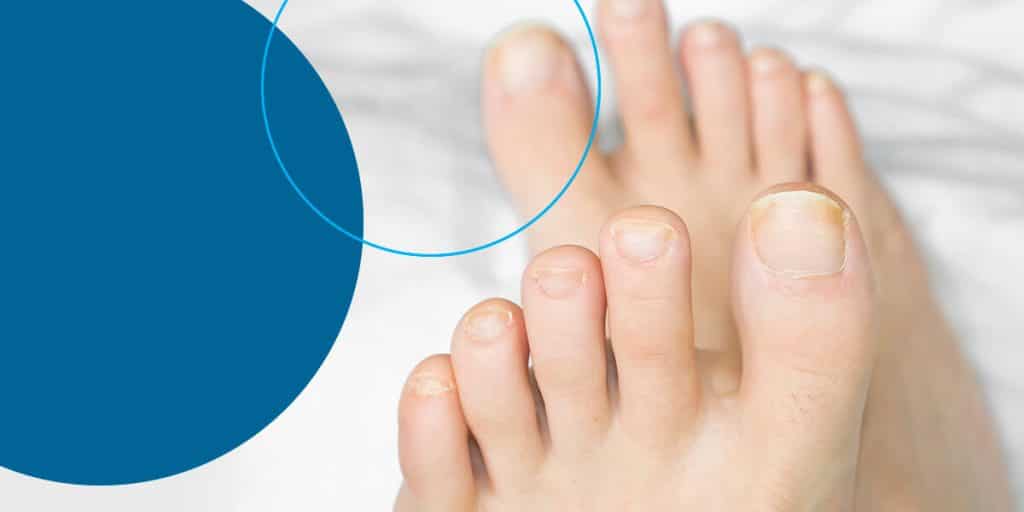 Toenail Fungus: Signs, Symptoms, Causes and Treatments – ActiveBeat – Your  Daily Dose of Health Headlines