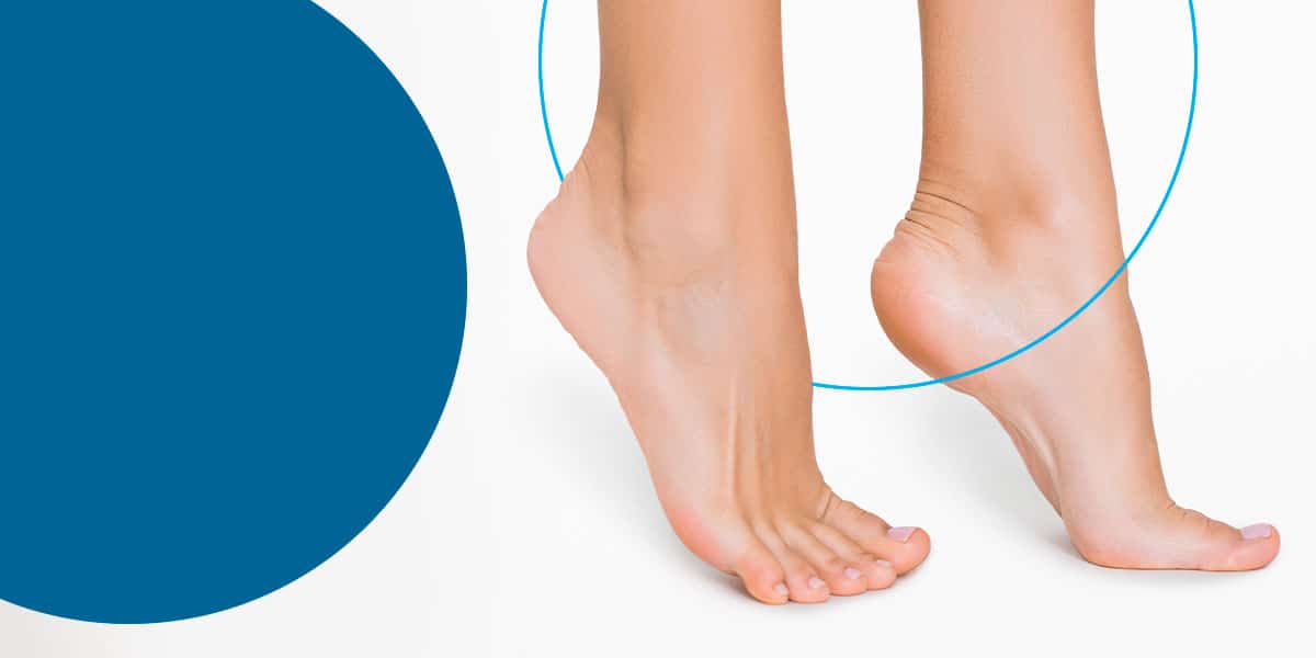 What Is the Difference Between Flat Feet vs. Arched Feet?