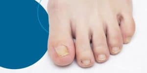 A close-up of a foot and it's toenails