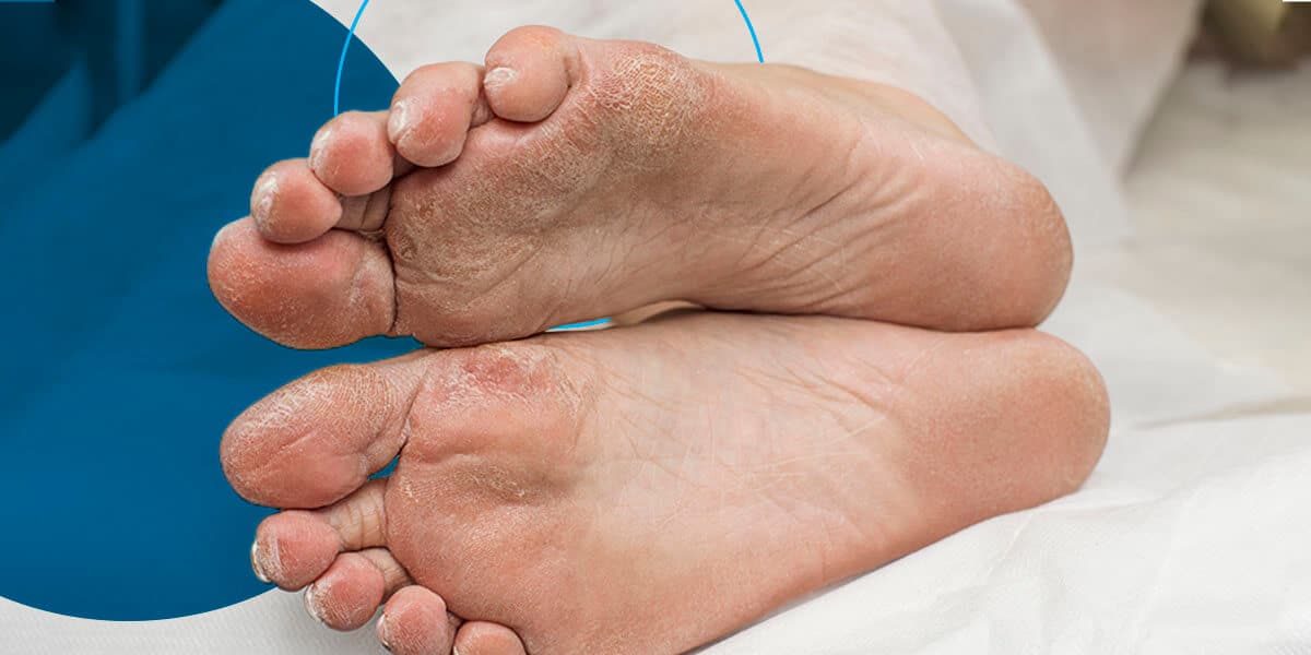bottom of feet that are dry and showing signs of diabetes