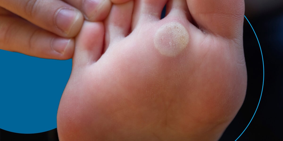 The underside of a foot with a plantar wart