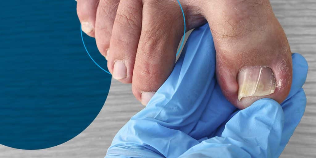 Let Our Podiatrists Help with Ingrown Toenails, Blog