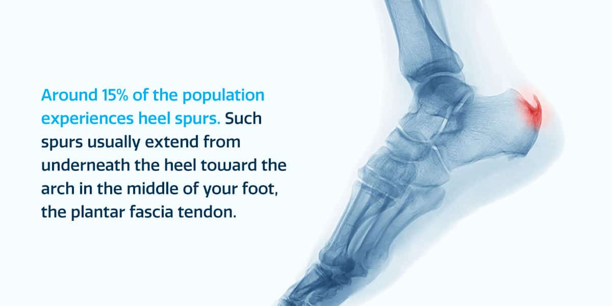 Signs Of A Heel Spur