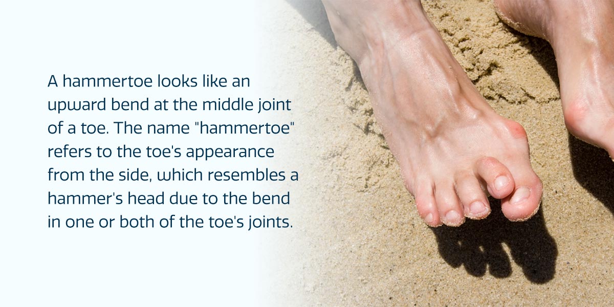 Hammertoe can be life-changing, treat it in time