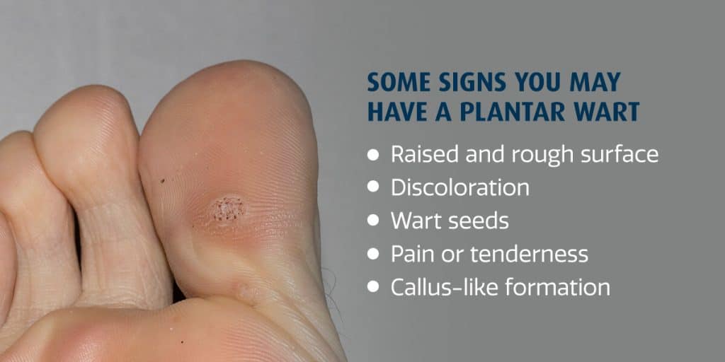 Can You Recognize Plantar Warts on Feet?