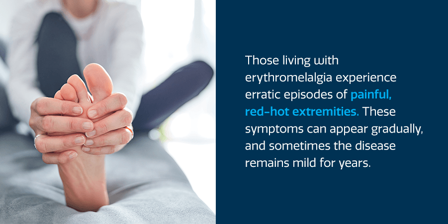 A person experiencing Erythromelalgia symptoms and holding their foot in their hands.